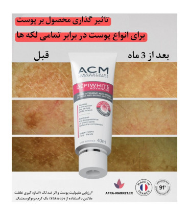 کرم ضدلک دپی وایت ای سی ام ACM